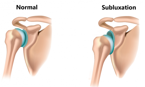 shoulder-dislocation-sublux-1301x670 shoulder-dislocation-sublux-1301x670